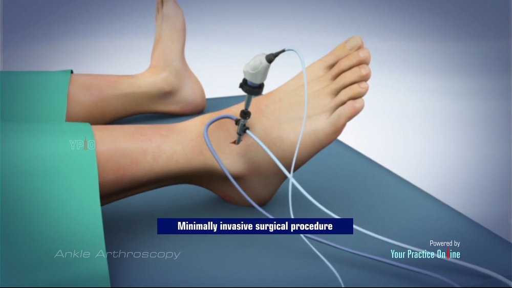 ankle-reconstruction-surgery-lateral-ankle-ligament-reconstruction