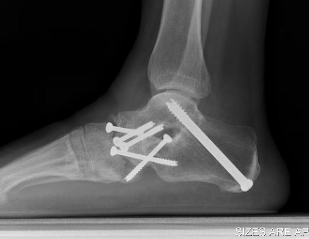 Advances in Ankle Fusion Surgery: Effect of Bone Morphogenetic Protein