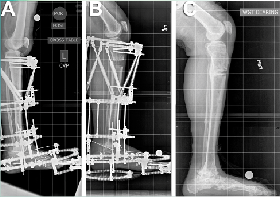 Clinical Applications of 3-D Printing In Orthopaedic Care