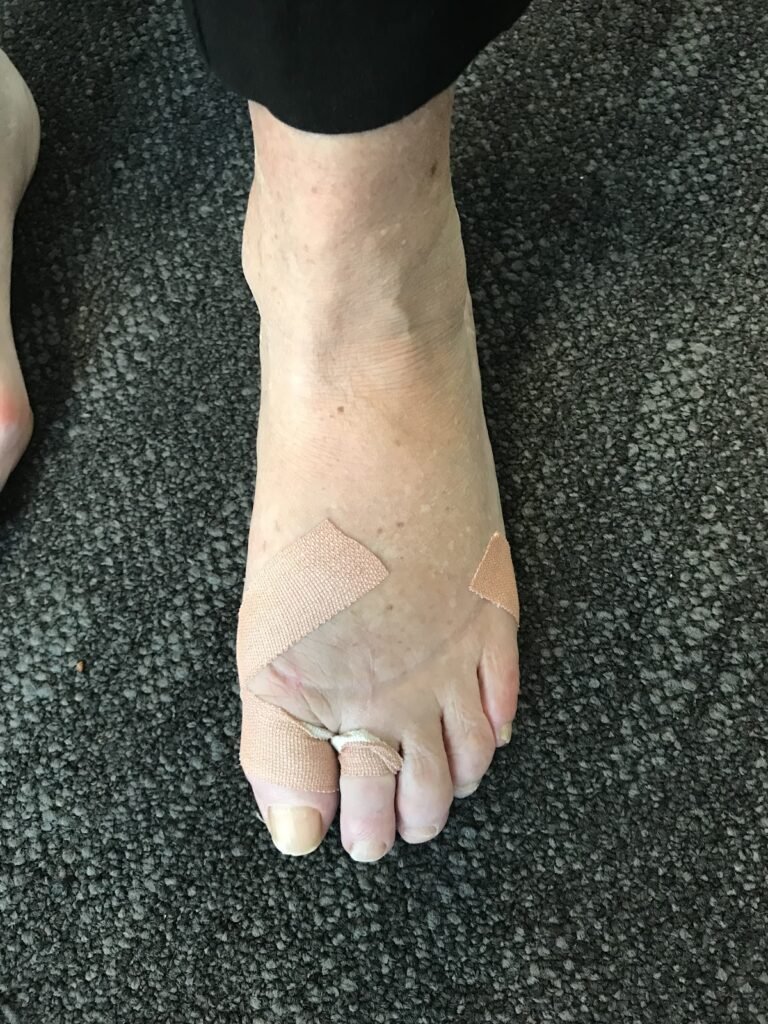 Post-Op Treatment for Bunions