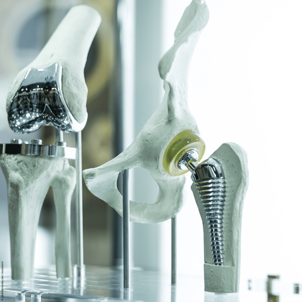 Smart Implants in Orthopedic Surgery