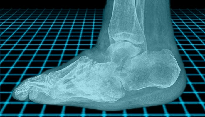 Diabetic Charcot Foot: Causes and Treatments