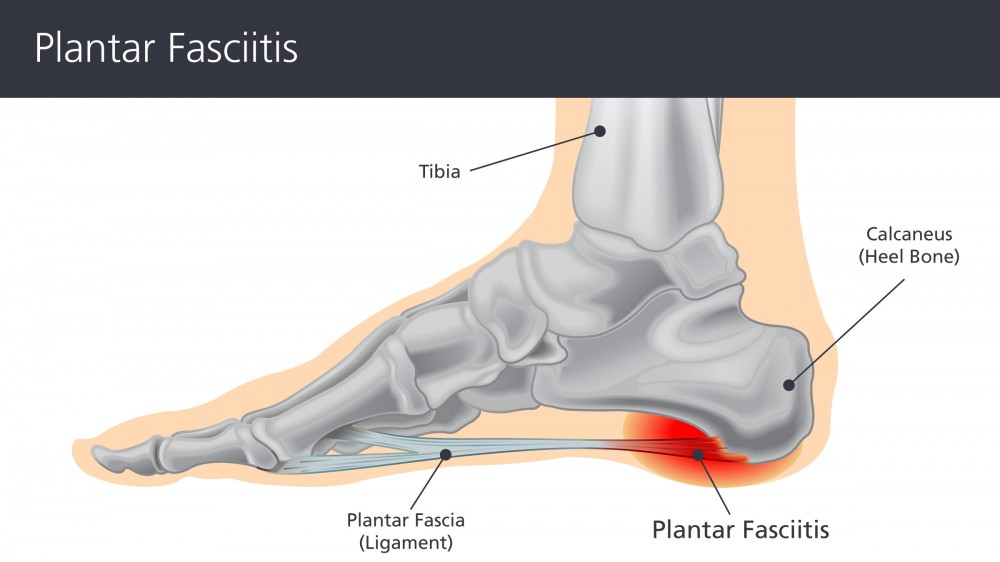plantar fasciitis